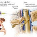 좌골신경통(Sciatica)의 원인과 증상, 적절한 치료법 이미지