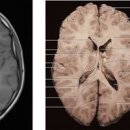 뇌 MRI, MRA 차이 &amp; 머리 CT 촬영, 검사 방법 및 . 이미지