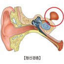 청신경종 (Acoustic Neuroma) 이미지