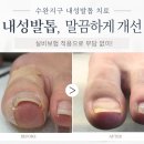 파리바게뜨이충2지구점 | 광주 내성발톱 병원 수완지구에서 실비 적용으로 부담 적게 치료받은 후기