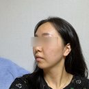 일리스스킨 | [대구] 무턱, 이중턱 하이푸 일리스킨 내돈내산 솔직후기