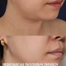 뉴코아아울렛괴정점 | 부산 사하구 피부관리 이중턱 고민이라면 괴정 엠제이뷰티샵 하이퍼젝션 라인관리 추천해요!