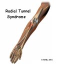 요골신경 포착 또는 요골관증후군 (Entrapment of Radial Nerve or Radial Tunnel Syndrome) 이미지