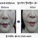 미러피부과성형외과 네이버블로그