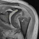 고령차유리 | 고령 환자에서 상완골 분쇄 골절, 왜 인공관절을 권할까?