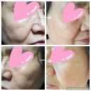 쎄라헤어 - 평택시 | 쿼드쎄라 펄샷 후기 2편. 땅콩형 탈출?! 가정용 하이푸 뷰티디바이스 꾸준히 써보니 달라진 피부 3주차...