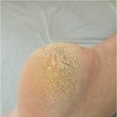 닥터아이티엔_로다살롱 | 대전 원신흥동 발각질 딱딱한 뒤꿈치 부드럽게 바꿔준 열개의손가락 닥터아이티엔 대전유성구점