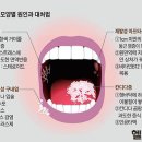 간이식후 입 안 자주 아프다… 구내염 원인 및 치료 이미지