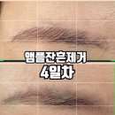 류앤뷰티 | 일산 앰플잔흔제거 핑크색눈썹 제거해보기