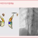 조기수축 ? 2단맥? 빈맥형 부정맥? 이미지