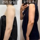 프롬미유 | 대전 신부 관리 전문 프롬미유 후기 / 대전 신부관리 추천 / 대전 신부 관리 팔뚝 전후 사진 공개