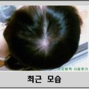 (주)두미래 | 심한 지성과 붉은 두피의 정수리 탈모 개선후기 (피부과추천 프로메톡 사용 후기)