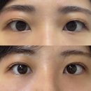 내돈내산 겹주름 자연유착 쌍수 후기 : 일주일, 한달, 6주차 붓기 빠지는 경과