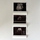 11500-5-37-07 | 춘천 미래산부인과 39주 4일차 제왕절개 출산 및 입원 후기