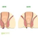 치질 원인과 종류 증상 치루, 치핵, 치열의 차이점 예방 방법 이미지