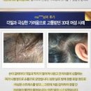머리두피통증 원인, 두피 아픔 빨감 화상 해결책 피부과 치료 방법 이미지