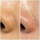 연화슈퍼 | 메디필 피지연화제 | 엑스트라 슈퍼9 플러스로 코피지 제거 후기