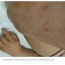 면회 금지된 요양병원서 &#39;옴&#39; 환자 발생..&#34;비위생 탓&#34; 호소 이미지