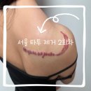 서울잉크타투 | 서울 타투 제거 후기 2회차