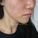 본연의 회복(절대적 | 서면 튠 페이스 잘하는곳 내돈내산 후기 , 예신관리