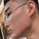 LK성형외과 | 광주 성형외과 턱 보톡스 효과 시술 후기/ 사각턱 고민 해결
