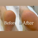 푸스케어 청량리역점 | [청량리]푸스케어청량리역점 발각질 후기