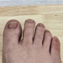 배크 | 남양주 별내피부과 발톱 무좀레이저 후기