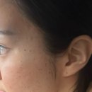 127 | [제주/노형] “하늘체한의원”에서 얼굴전체 편평사마귀 27만원에 총 127개 제거 후기(내돈내산)