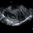 이도메디 | 창원 엘르메디 임신 초기 6주 - 13주 피고임 하혈