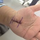 서울척탑병원 | 손목터널증후군 수술1일차