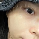 하나한의원 | 부산 서면 편평사마귀 제거 한의원 대만족 후기