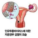 여성암 자궁암의 원인 - HPV 인유두종 바이러스 이미지