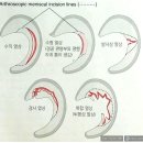 무릎통증의 종류중 하나인 반월상연골파열 (부제 : [하] 비수술/수술 치료방법,생활가이드 제시) 이미지