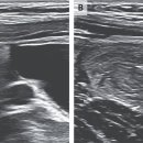 Small-Bowel Intussusception in a Child_장중첩증 이미지