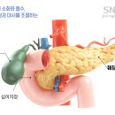 췌장암의 다양한 예후 이미지