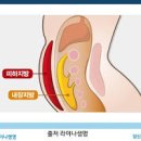 내장지방 내장지방 빼는 법 내장비만 관련 질환 내장지방 줄이는 방법 이미지