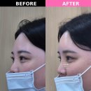 쌤소롯데창원 | 창원 상남동 이마필러 가격 통증 부작용 자연스러운 볼륨 후기