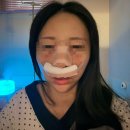 코 | 기능코 + 코성형 후기 ② | 수술 후 1주일 회복과정 (붓기·멍·솜제거 리얼후기)