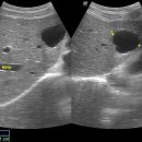 Hydatid cyst of the liver 이미지