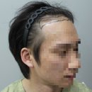 모제림성형외과의원 | 예랑이 '모발이식'하고 왔어요🌱(내돈내산)1탄 모제림성형외과 모발이식