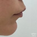 더리터망정점 | 잠실 입술필러 후기: 가격, 1~4일차 붓기, 통증, 멍, 전후 비교 (내돈내산)