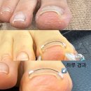 올림픽공원역 2번출구(앞) | [송파내향성발톱관리 후기] 하루 만에 고통에서 해방! 올림픽공원역네일 전문샵, 닥터아이티엔 러블리...