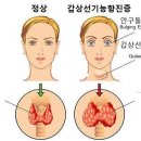 음식과 질환 - 갑상선기능항진증 이미지