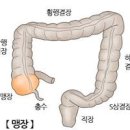 맹장 위치 여자 남자 맹장염 통증 원인 치료 및 예방방법 이미지