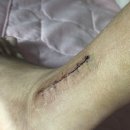 디딤동물병원 | 삼복사 골절 수술부터 수술 후 4주차까지의 기록