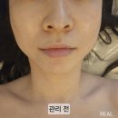 창원리프팅 상남동피부관리 올오브뷰티 특수관리 하이푸 후기