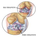 [십자인대파열] 십자인대파열 등 겨울 스포츠 도중 부상 예방하려면 이미지