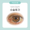 [이안안과]50대 재발없는 군날개, 익상편 수술 후기