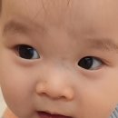 김남주이비인후과의원 | 24개월 두돌아기 안검내반 수술후기 (분당서울대병원)