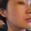 대구동성로예쁨주의쁨의원 | 대구동성로피부과 예쁨주의쁨의원 스킨부스터 필로드 후기